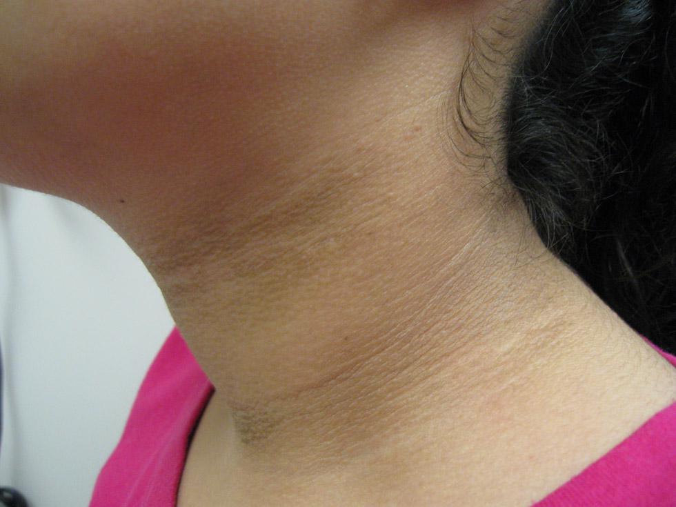 Featured image of post The Best 11 What Causes Acanthosis Nigricans In Child